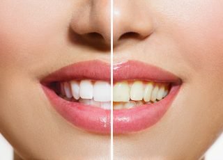 Woman Teeth Before and After Whitening. Over white background. Happy smiling woman. Dental health Concept. Oral Care.
