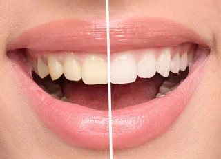teeth-whitening-before-and-after (1)